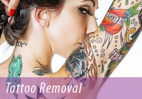 tattoo removal cda