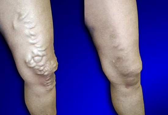 Varicose Vein Treatment - Legs