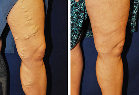 Varicose Vein Treatment - Legs