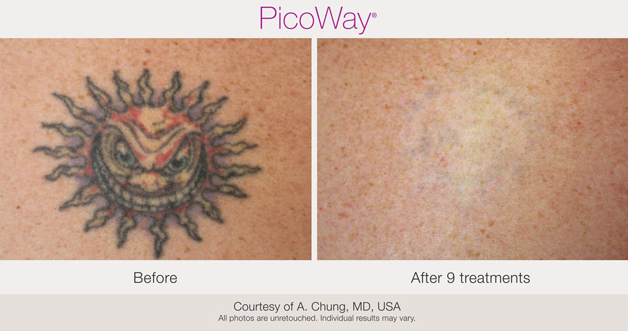 sun tattoo removal before and after