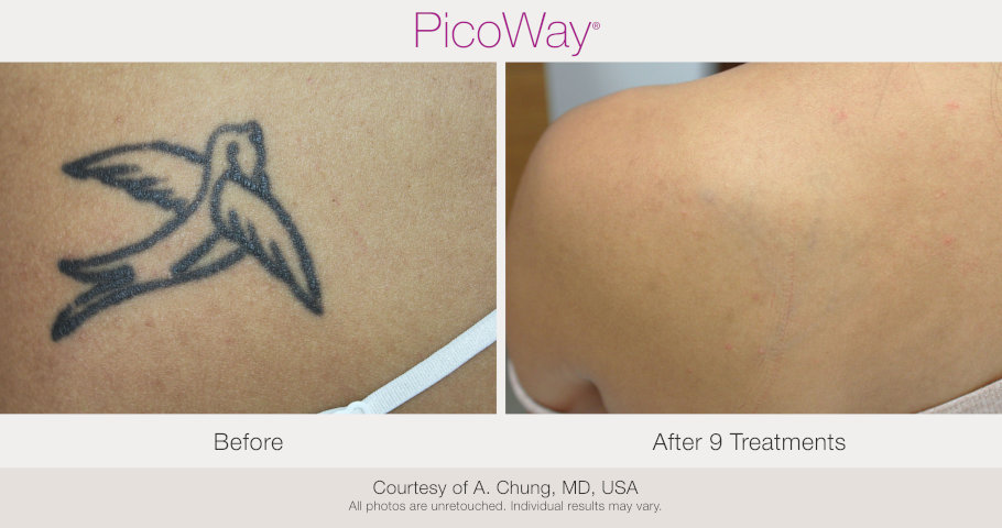 tattoo removal bird before and after